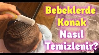 Bebeklerde Konak Nasıl Geçer bebeklerdekonak konak [upl. by Dorcea844]