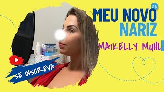 Minha tão sonhada Rinoplastia  Cirurgia estética no Nariz Veja o Antes e Depois [upl. by Evelin]