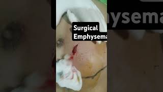 Surgical emphysema Surgitube doctor [upl. by Hgalehs]