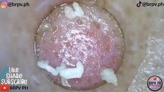 PORE VACUUM BLACKHEAD REMOVAL DEMO FOR Week32 CLASSICAL MUSIC brpvph​satisfying [upl. by Ihtac]