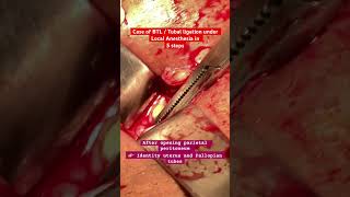 Bilateral Tubal Ligation Explained Procedure Recovery amp FAQsdrmouzamalirana obstetrician [upl. by Lampert44]