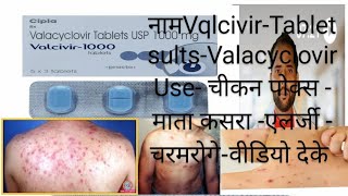 Valcivir 1000 mg Tablets Valacyclovir tablet चिकन पोक्स एलर्जी valacyclovir use Dosage Herpival [upl. by Kean]