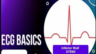 ECG Basics  Inferior wall STEMI [upl. by Ellata664]