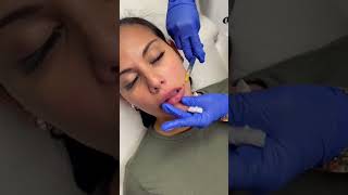 Lip filler cannula technique [upl. by Ahsiaa639]