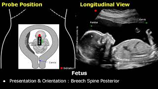 Obstetric Ultrasound Probe Positioning  Pregnant Uterus amp Fetus Transducer Placement USG Scan [upl. by Aimal]