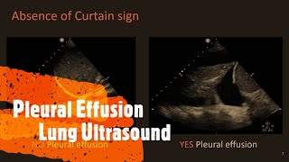 Pleural Effusion Lung Ultrasound Perioperative amp Critical Care POCUS [upl. by Zeiler]