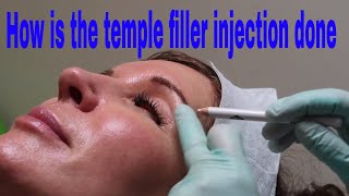 How is the temple filler injection done [upl. by Navannod]