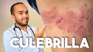 TODO SOBRE LA CULEBRILLA  HERPES ZÓSTER [upl. by Lordan590]