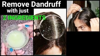 Magical Home Remedy to Remove DANDRUFF at homeDandruff treatmentHow to get rid of dandruff [upl. by Aida449]