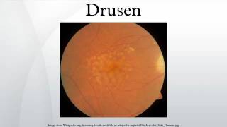 Drusen [upl. by Lovato2]