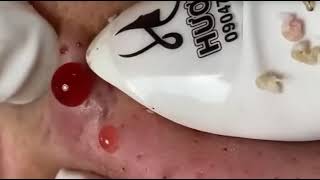 Pimple Pop Part 2 [upl. by Varuag]