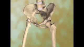 Osteoarthritis of the Hip [upl. by Nylynnej]