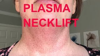 LIVE Neck lift without surgery  My Plasma Fibroblast Necklift 2 [upl. by Jaret]