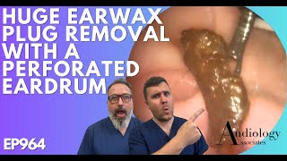 HUGE EAR WAX PLUG REMOVAL WITH A PERFORATED EARDRUM  EP964 [upl. by Selena]