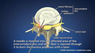 Treatment of lower back pain PLDD Therapy [upl. by Ros]