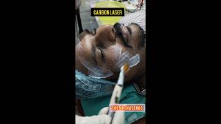 Carbon laser treatmentShubiksha hairampskin care clinicprpgfcbalajinagarkatturtrichy9150923153 [upl. by Fatima]