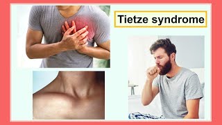 Tietze syndrome [upl. by Neenad]