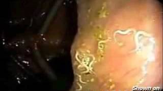 Worms parasites In the Human Intestinal Tract [upl. by Rissa]