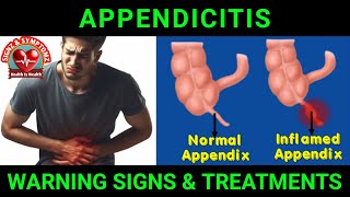 Appendicitis Symptoms and Treatment Options appendicitis [upl. by Noreen777]