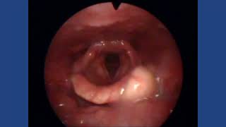 Epiglottic Cyst [upl. by Heida354]