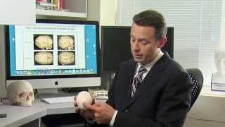 Craniosynostosis Treatment Options for Sagittal Synostosis  Part 5 of 6 [upl. by Jammin]