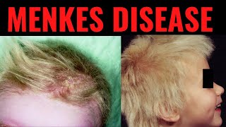 MENKES Kinky Hair DISEASE Symptoms Causes Signs Treatment  What is Menkes Disease [upl. by Sura]