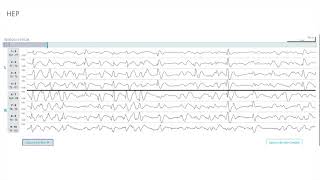 EEG Atlas B3 Understand EEG Through Examples With The Ceribell Rapid Response System [upl. by Flosser77]