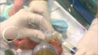 Neonatal Digital Intubation Part 2 [upl. by Nettle]