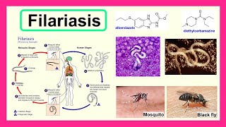 filariasis [upl. by Zemaj]