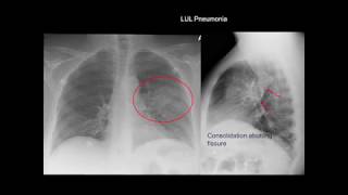 Cardiac borders and chambers in Chest X Ray [upl. by Irmgard534]