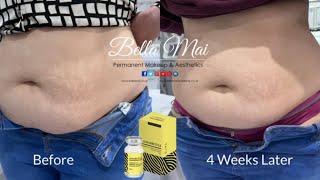 Lemon Bottle Fat Dissolver  STOMACH  Before amp 4 Weeks Later [upl. by Landers]