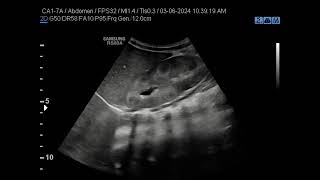 Medullary Nephrocalcinosis [upl. by Gonsalve]