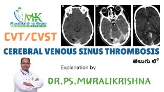 Cerebral Venous Sinus Thrombosis in telugu CVTCVST  DrPSMuralikrishna  Neurologist  Brain [upl. by Secnarf]