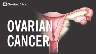 5 Warning Signs and Risk Factors of Ovarian Cancer [upl. by Benedicta]