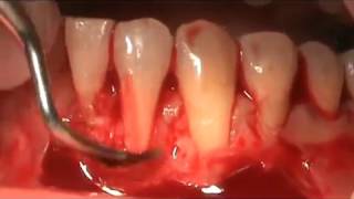 INJERTO GINGIVAL LIBRE [upl. by Ennayrb595]