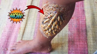 Worms Body  How to Remove Worms On Dandruff 347 [upl. by Ruelle481]