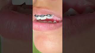 Impacted Canine 24 months Braces Timeline  Orthodontic Traction  Tooth Time Family Dentistry [upl. by Ulphi]