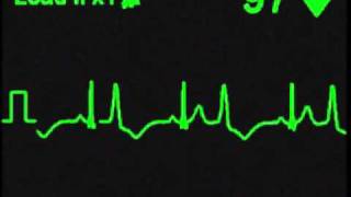 Ventricular Bigeminy  ECG Simulator  Arrhythmia Simulator [upl. by Aivart]