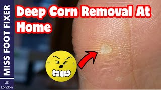 Deep corn Removal At Home  2022 Full Treatment By Miss Foot Fixer [upl. by Asilegna]