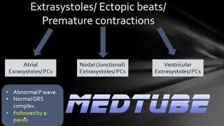 ECGs abnormal rhythms Extrasystoles [upl. by Enelrae]