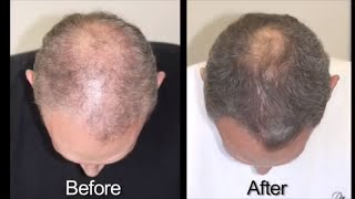 Hair Loss Treatment for Men with Advanced Trichology [upl. by Benedick]