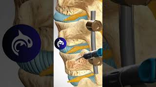 See how a Lumbar Fusion of the Spine works in 3D animation backpain stem spine [upl. by Ibocaj]