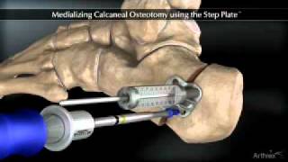 Medializing Calcaneal Osteotomy [upl. by Culosio]