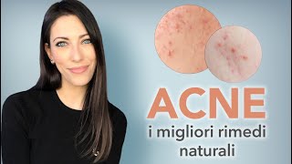 I migliori rimedi naturali per l’acne [upl. by Anagrom133]