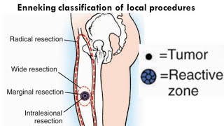 Bone Tumours for the FRCS orth [upl. by Wellington858]