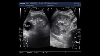 A large Adrenal tumor [upl. by Ddal]