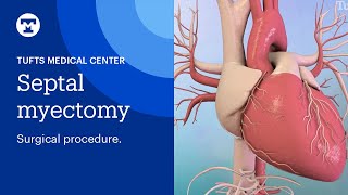 Septal Myectomy Surgical Procedure for Hypertrophic Cardiomyopathy HCM Tufts Medical Center [upl. by Colon1]