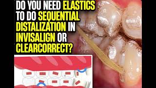 Do You NEED Elastics with Sequential Distalization in Invisalign Clear Aligners [upl. by Izaak836]