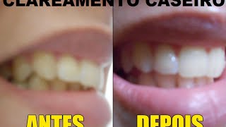 Clareamento Dental CASEIRO Com LIMÃO Resultado surpreendente Na Primeira Aplicação [upl. by Richmound]