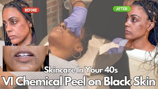 How To Treat Hyperpigmentation and Dark Spots on Black Skin Using A VI Precision Plus Chemical Peel [upl. by Sollars404]